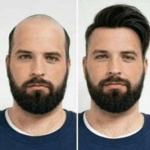 Hair Patch